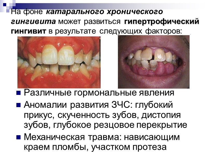 На фоне катарального хронического гингивита может развиться гипертрофический гингивит в результате следующих факторов: Различные
